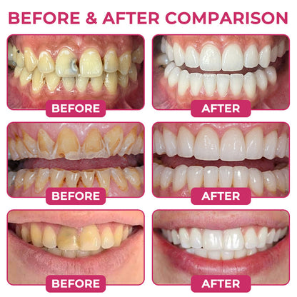 🇺🇸GarageLine® DenPerm Cavity-Repair Natural Enamel Filling Gel
